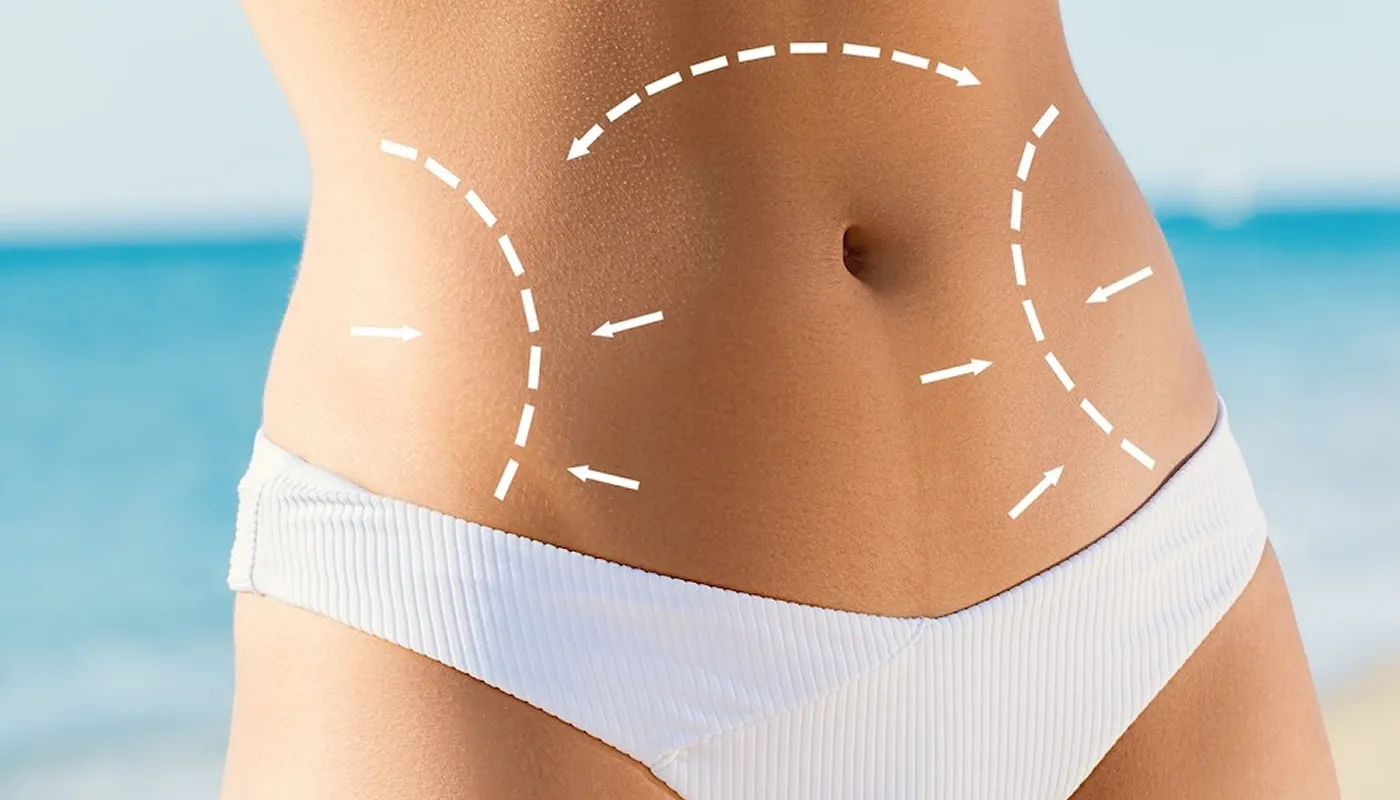 Abdominoplastia: Más allá de la estética | Dr. Allan Pérez - Recupera tu comodidad tras la maternidad o cambios de peso. Conoce el abordaje individual y las expectativas reales con el Dr. Allan Pérez Baltodano