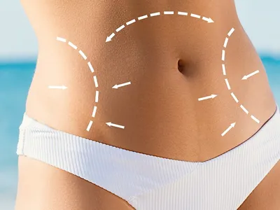 Abdominoplastia: Más allá de la estética | Dr. Allan Pérez